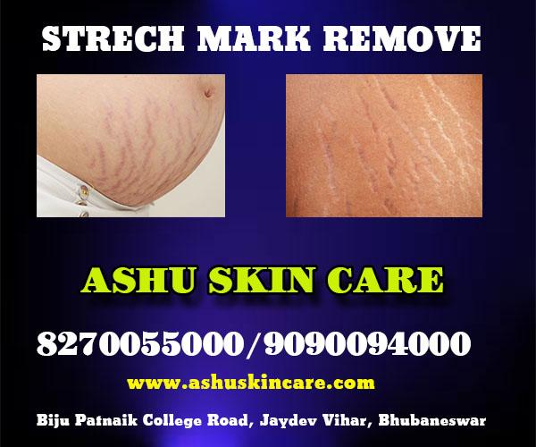best strech mark remove clinic in bhubaneswar near me